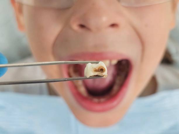 Best Emergency Tooth Extraction in Summit Hill, PA